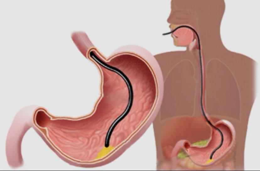 Endoscopia Digestiva Alta